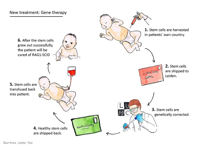 An infographic shows how stem cell gene therapy works. Stem cells are harvested in the patient's own country. These are genetically corrected in the LUMC and shipped back as healthy stem cells. These are transfused back into the patient, and once the stem cells have grown out successfully, the patient is cured of RAG1-SCID.