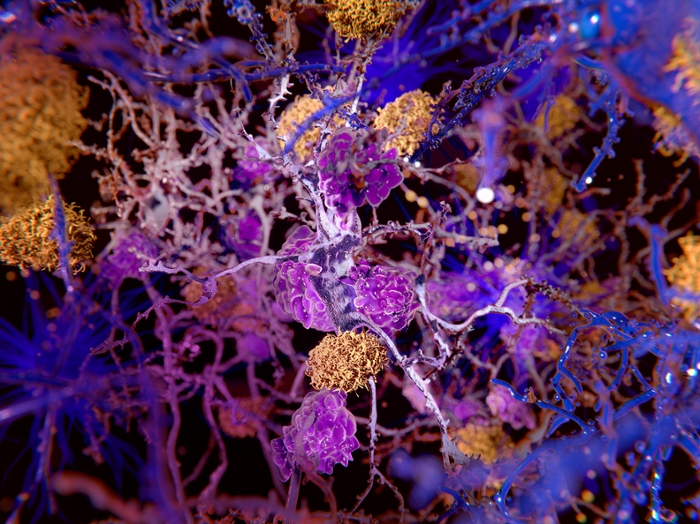 Computerbeeld van hersen¬weefsel bij de ziekte van Alzheimer: ophoping van eiwit-plaques (geel) leidt tot aftakeling van zenuwcellen (grijs), die vervolgens worden vernietigd door opruimcellen (paars).