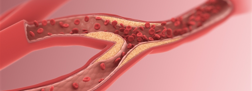Why arteriosclerosis looks like an autoimmune disease - Leiden University Why arteriosclerosis looks like an autoimmune disease - Leiden University