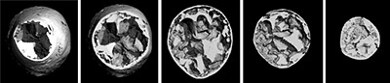 CT scans of the cyst